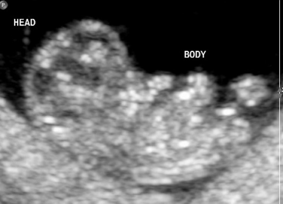 early pregnancy scan