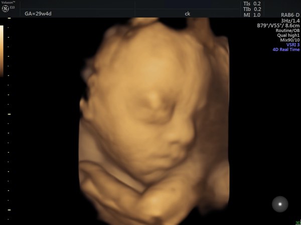 third trimester scan