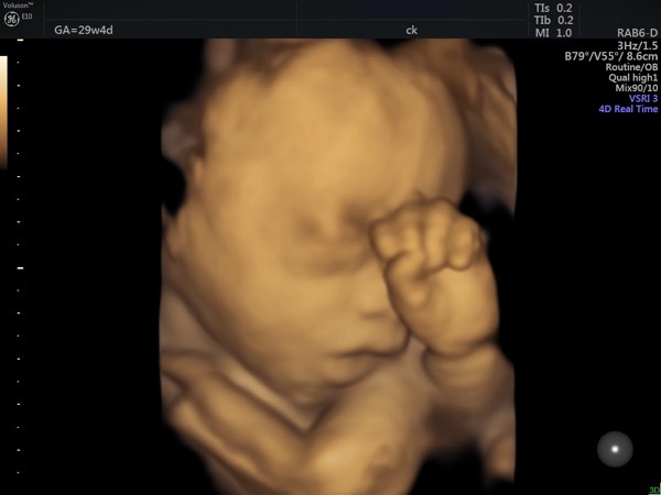 third trimester scan