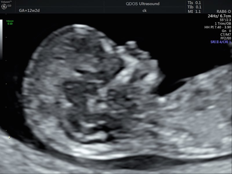 12 week scan