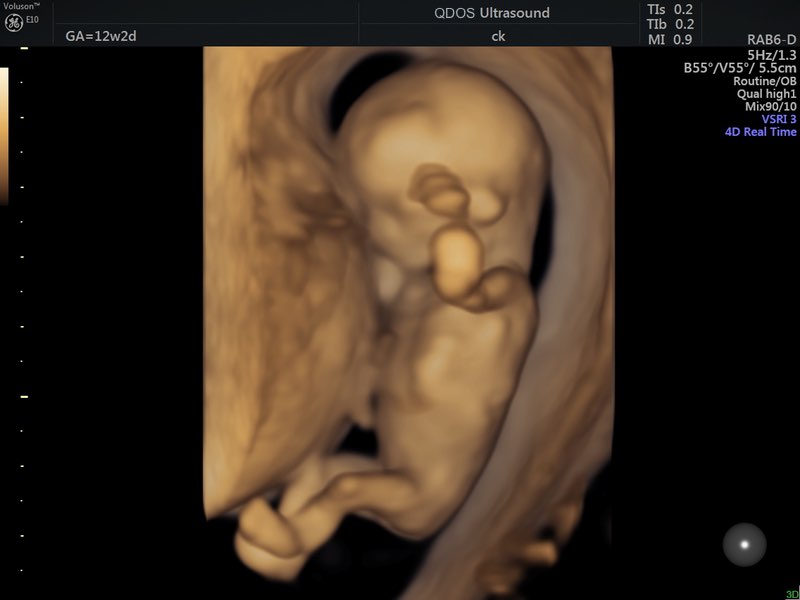 12 week scan