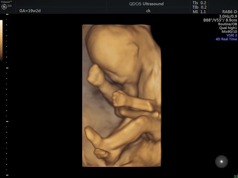 19 week scan