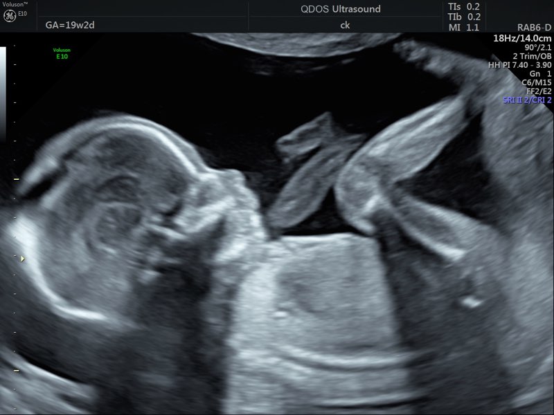 19 week scan