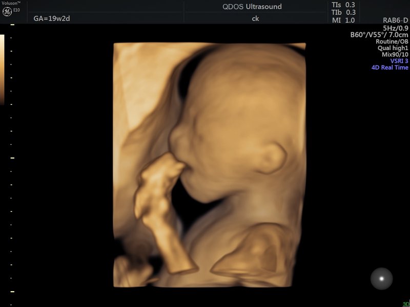 3D and 4D ultrasound