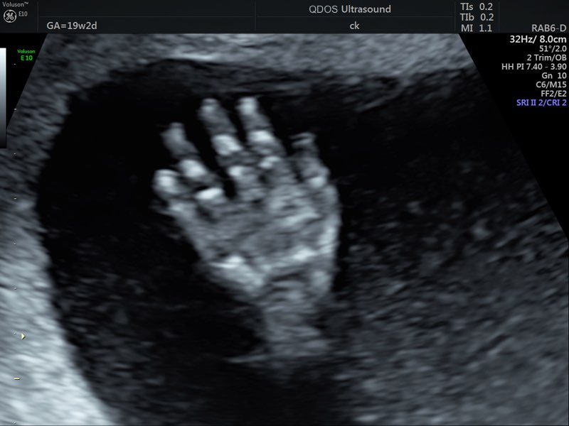 19 week scan