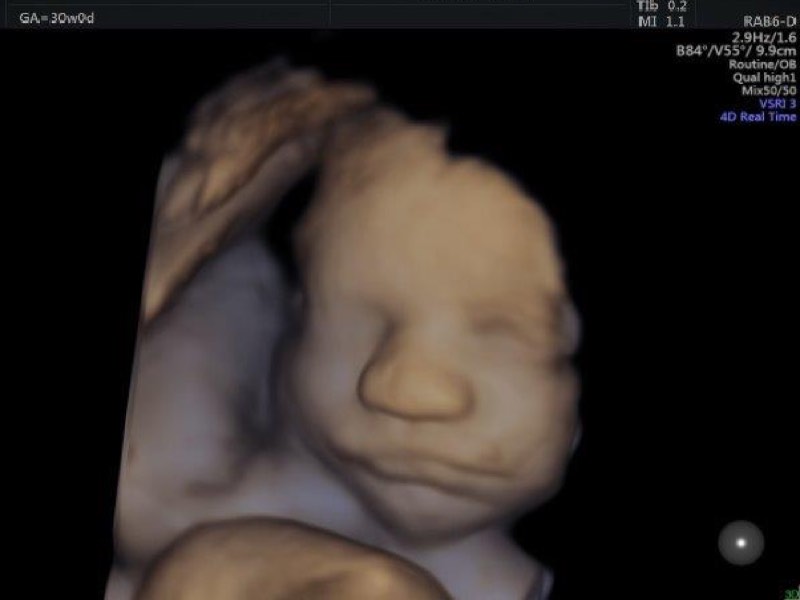 third trimester scan