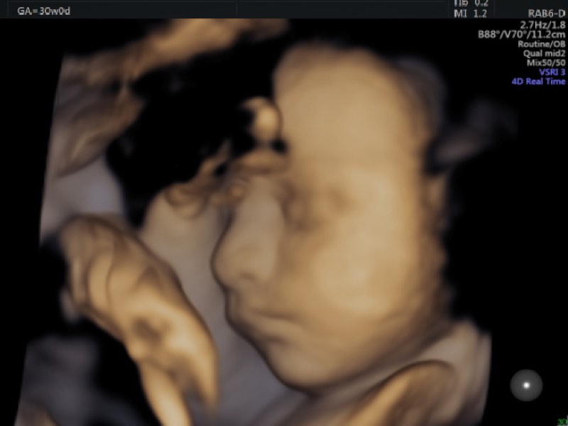 third trimester scan