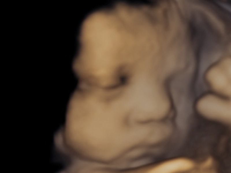 third trimester scan